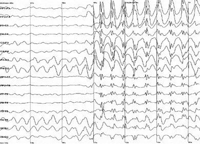 EEG%20epilepsie